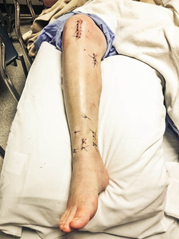 Here's What Joey Jordison's Leg Looked Like After Surgery ...